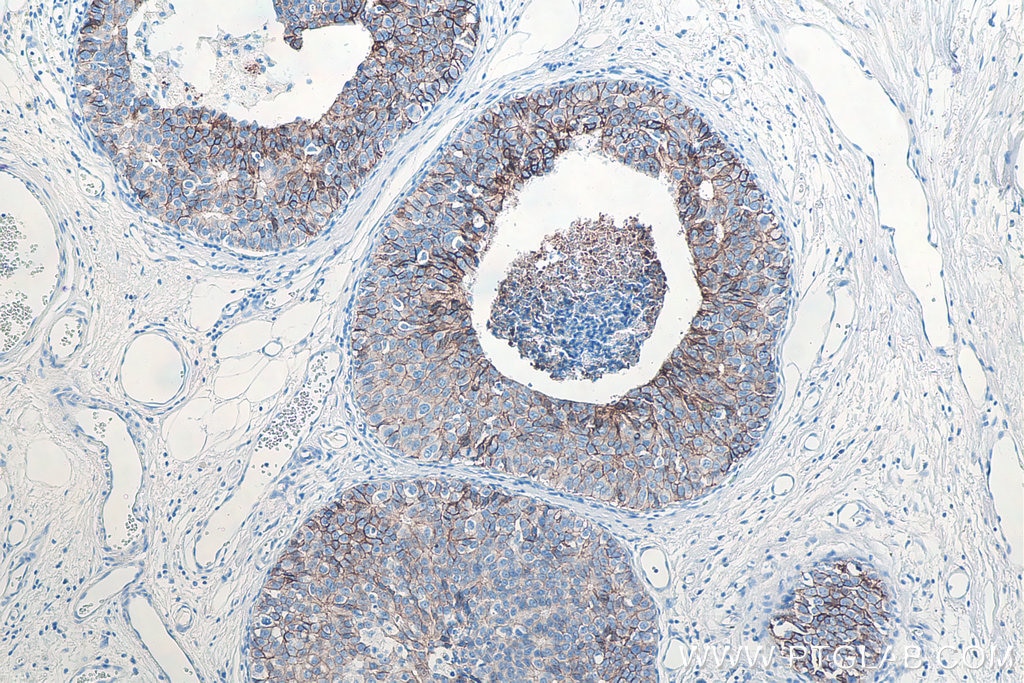 IHC staining of human breast cancer using 60335-1-Ig Immunohistochemistry (IHC) staining of human breast cancer tissue using E-cadherin Monoclonal antibody (60335-1-Ig)
