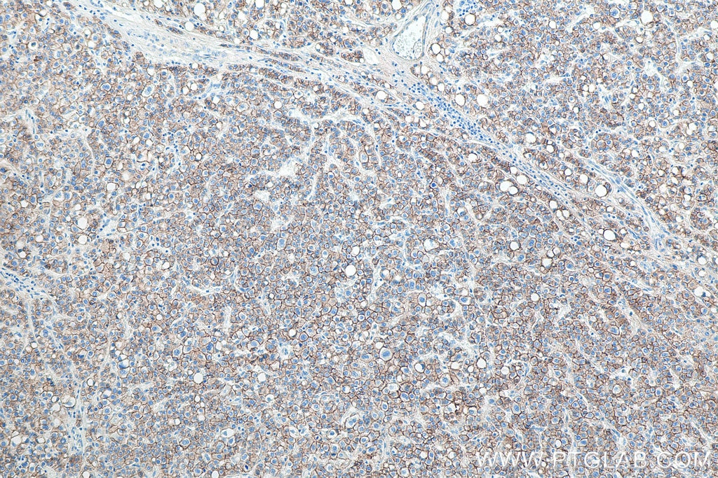 IHC staining of human liver cancer using 60335-1-Ig Immunohistochemistry (IHC) staining of human liver cancer tissue using E-cadherin Monoclonal antibody (60335-1-Ig)