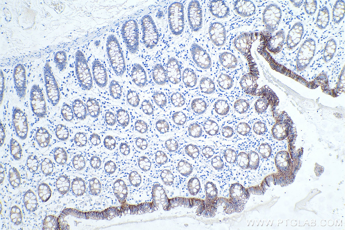IHC staining of human colon using 60335-1-Ig Immunohistochemistry (IHC) staining of human colon tissue using E-cadherin Monoclonal antibody (60335-1-Ig)