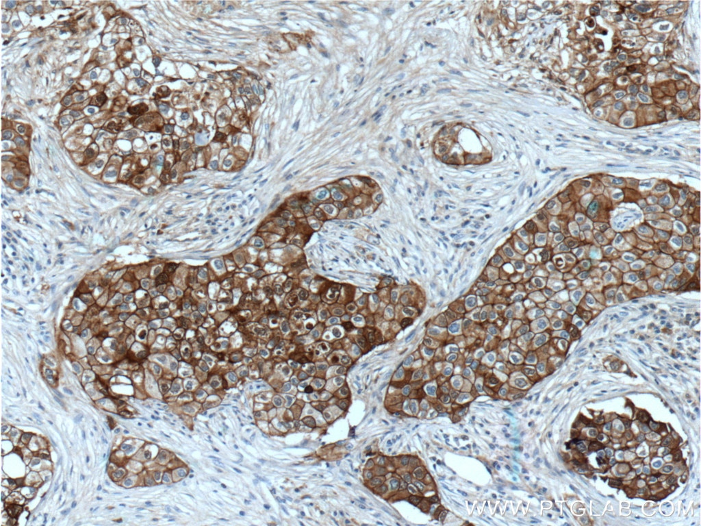Immunohistochemistry (IHC) staining of human breast cancer tissue using E-cadherin Monoclonal antibody (60335-1-Ig)