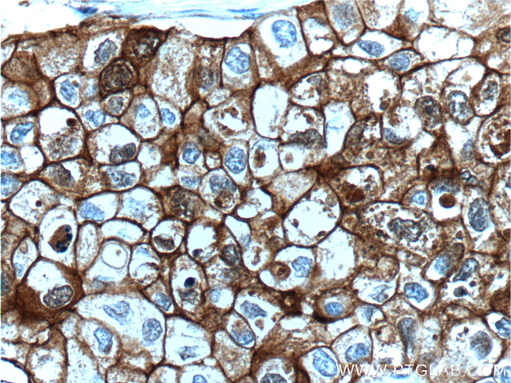 IHC staining of human breast cancer using 60335-1-Ig