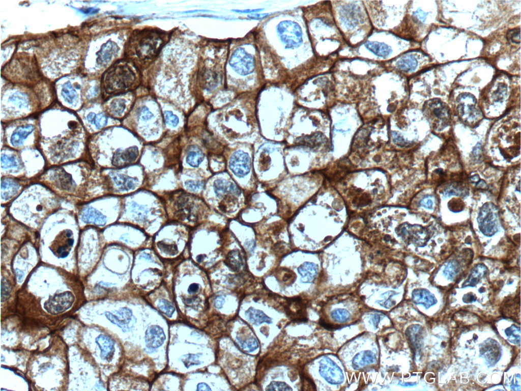 Immunohistochemistry (IHC) staining of human breast cancer tissue using E-cadherin Monoclonal antibody (60335-1-Ig)