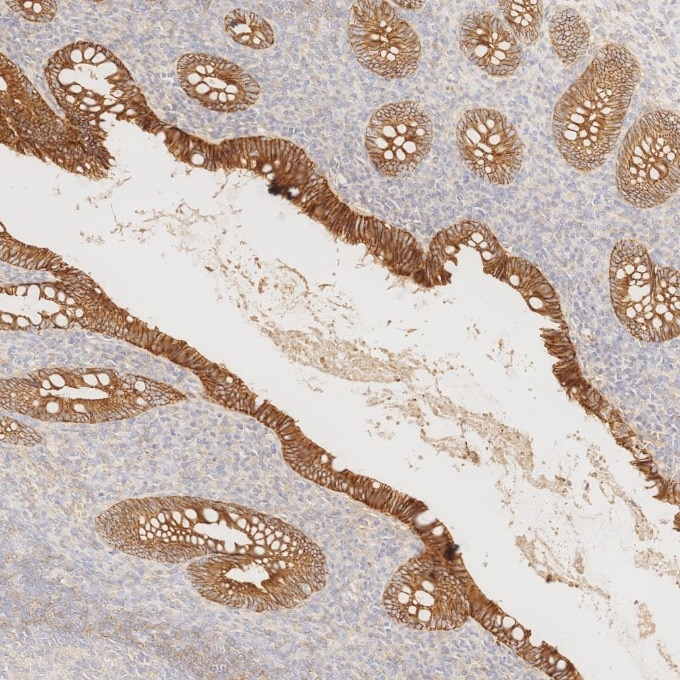 Immunohistochemistry (IHC) staining of human appendicitis tissue using E-cadherin Monoclonal antibody (60335-1-Ig)