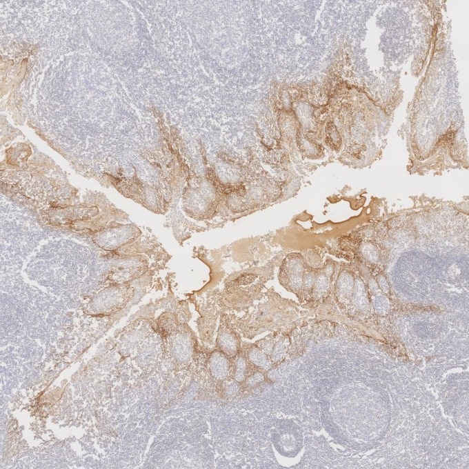 Immunohistochemistry (IHC) staining of human tonsillitis tissue using E-cadherin Monoclonal antibody (60335-1-Ig)