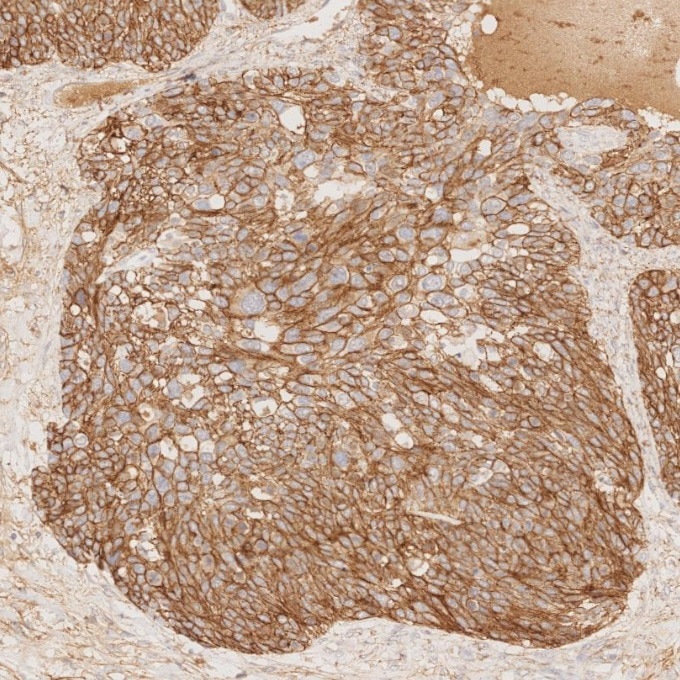Immunohistochemistry (IHC) staining of human ovary cancer tissue using E-cadherin Monoclonal antibody (60335-1-Ig)