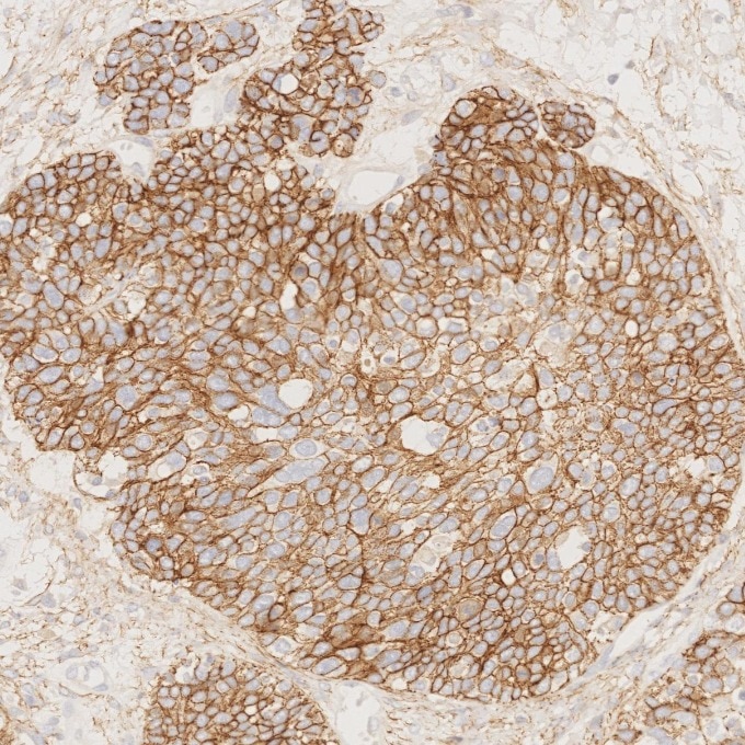 Immunohistochemistry (IHC) staining of human ovary cancer tissue using E-cadherin Monoclonal antibody (60335-1-Ig)