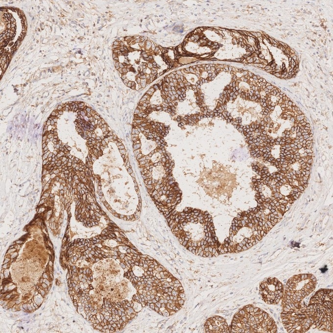 Immunohistochemistry (IHC) staining of human breast cancer tissue using E-cadherin Monoclonal antibody (60335-1-Ig)