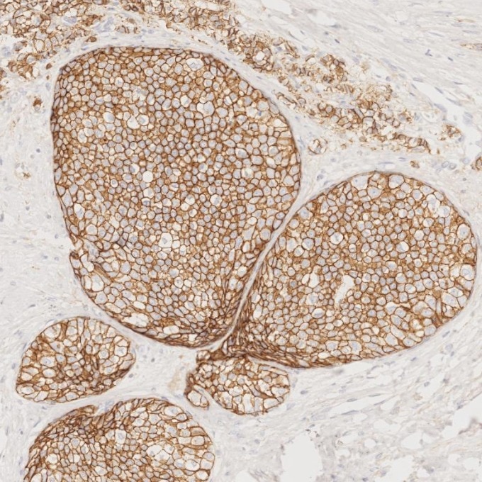 Immunohistochemistry (IHC) staining of human breast cancer tissue using E-cadherin Monoclonal antibody (60335-1-Ig)