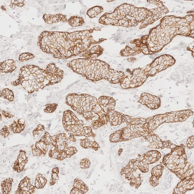 Immunohistochemistry (IHC) staining of human breast cancer tissue using E-cadherin Monoclonal antibody (60335-1-Ig)