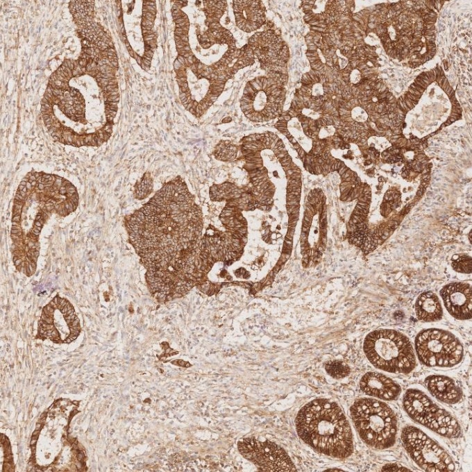 Immunohistochemistry (IHC) staining of human colorectal cancer tissue using E-cadherin Monoclonal antibody (60335-1-Ig)
