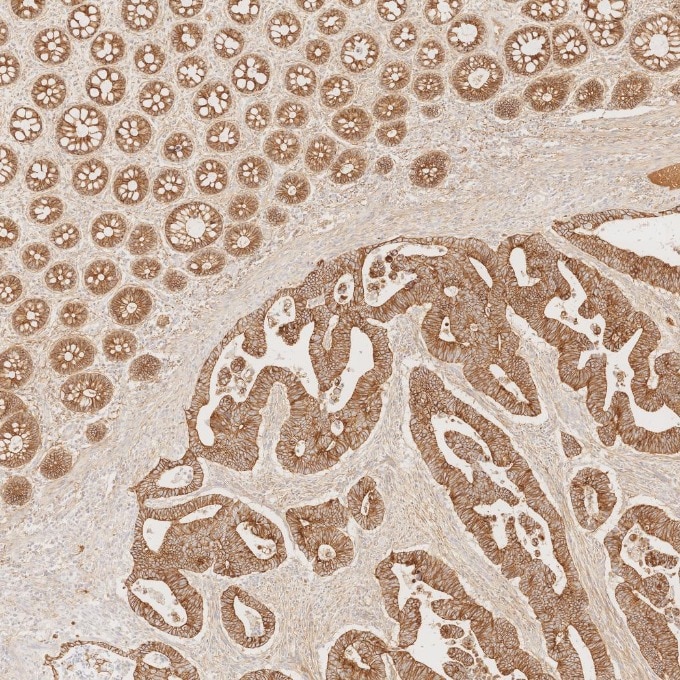 Immunohistochemistry (IHC) staining of human colorectal cancer tissue using E-cadherin Monoclonal antibody (60335-1-Ig)