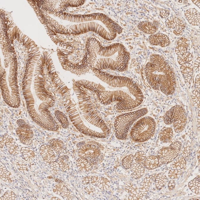 Immunohistochemistry (IHC) staining of human stomach cancer tissue using E-cadherin Monoclonal antibody (60335-1-Ig)