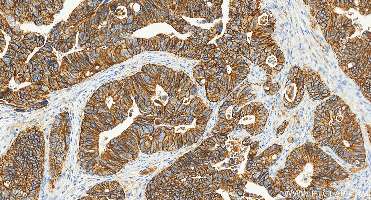 Immunohistochemistry (IHC) staining of human colon cancer tissue using E-cadherin Monoclonal antibody (60902-1-Ig)