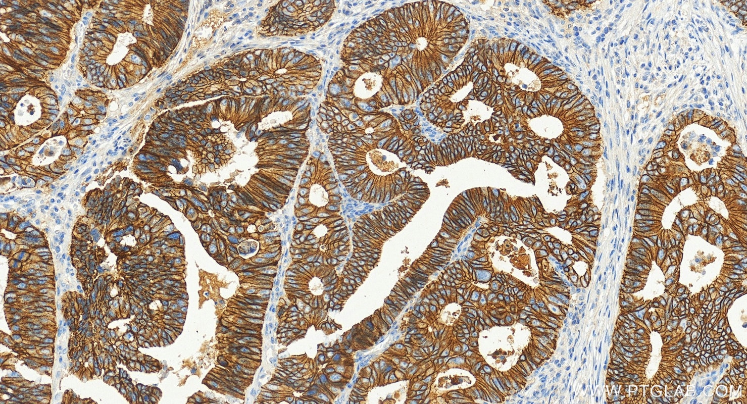 Immunohistochemistry (IHC) staining of human colon cancer tissue using E-cadherin Monoclonal antibody (60902-1-Ig)