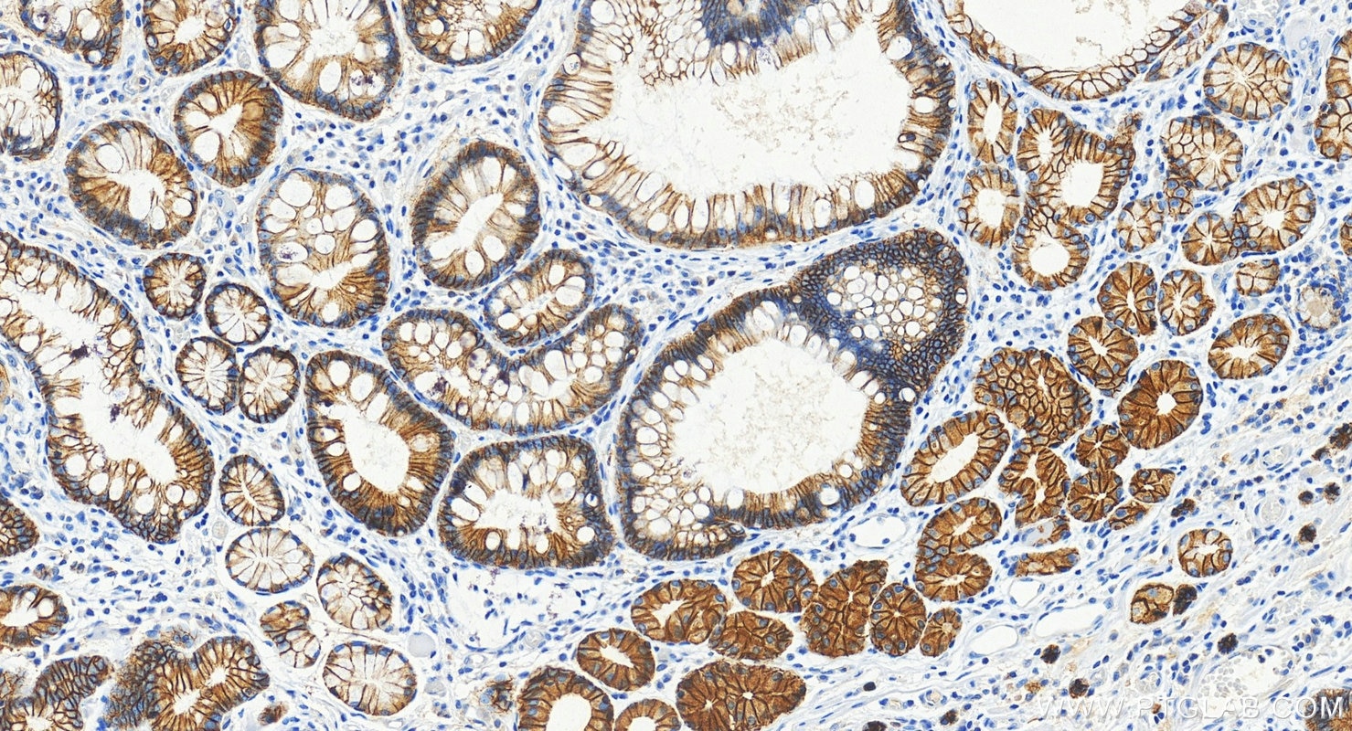 Immunohistochemistry (IHC) staining of human stomach cancer tissue using E-cadherin Monoclonal antibody (60902-1-Ig)