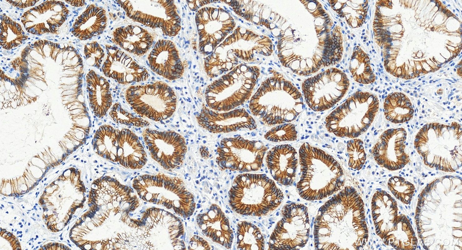 Immunohistochemistry (IHC) staining of human stomach cancer tissue using E-cadherin Monoclonal antibody (60902-1-Ig)