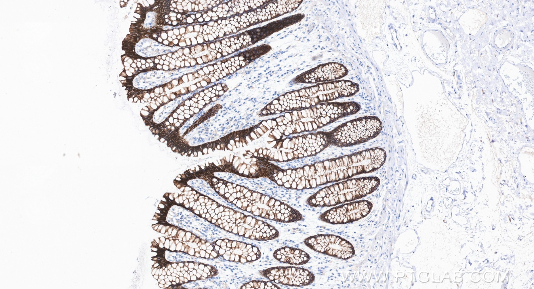IHC staining of human large intestine using 80541-5-RR Immunohistochemistry (IHC) staining of human large intestine tissue using E-cadherin Recombinant monoclonal antibody (80541-5-RR)