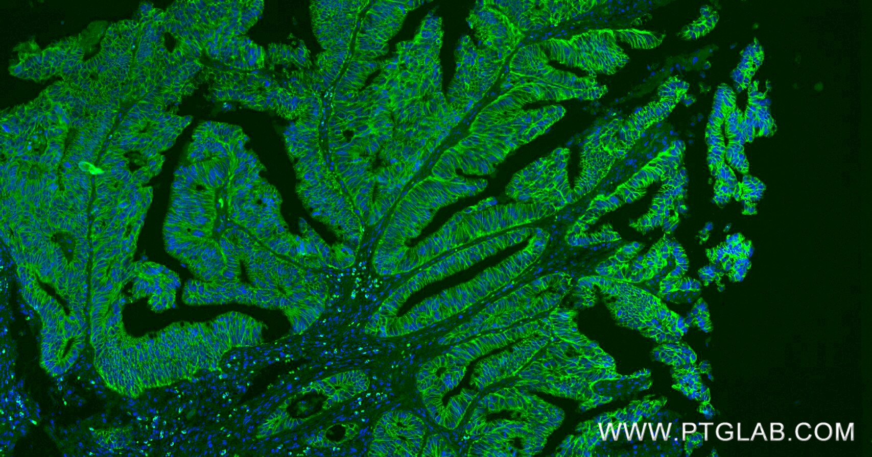 Immunofluorescence (IF) / fluorescent staining of human colon cancer tissue using E-cadherin Recombinant monoclonal antibody (80541-7-RR)