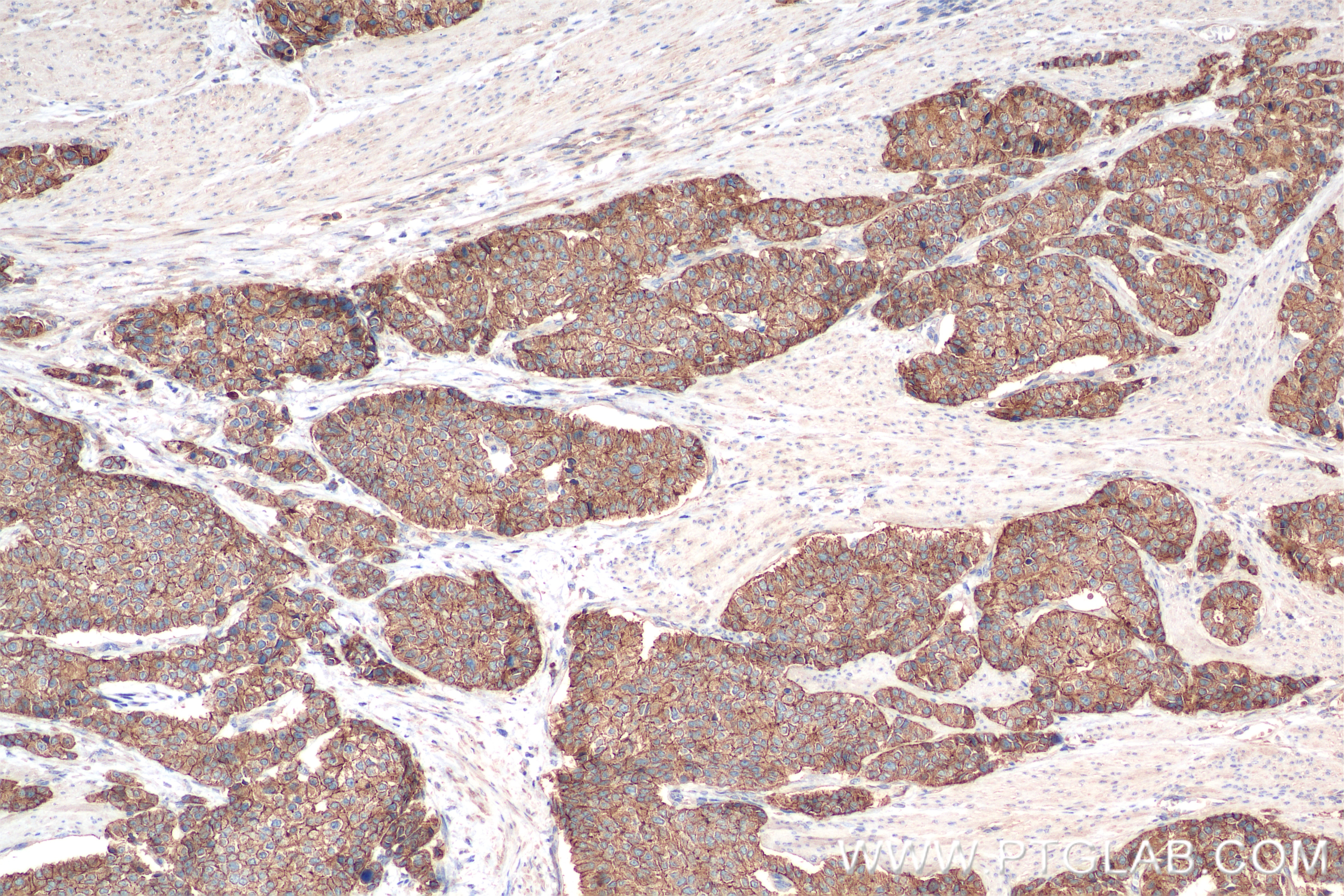 Immunohistochemistry (IHC) staining of human stomach cancer tissue using E-cadherin Recombinant antibody (80541-9-RR)