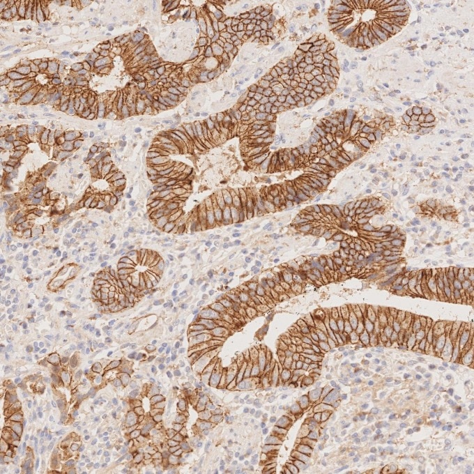 Immunohistochemistry (IHC) staining of human stomach cancer tissue using E-cadherin Recombinant monoclonal antibody (83991-4-RR)