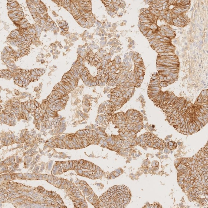 Immunohistochemistry (IHC) staining of human colorectal cancer tissue using E-cadherin Recombinant monoclonal antibody (83991-4-RR)