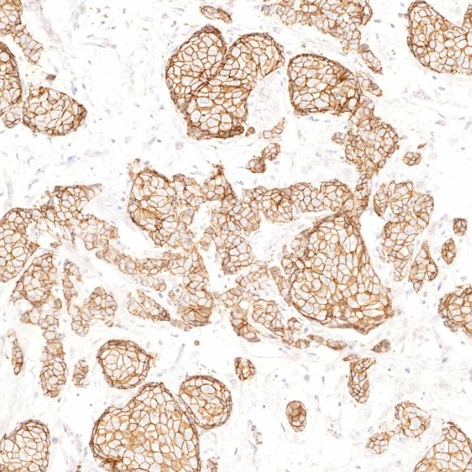 Immunohistochemistry (IHC) staining of human breast cancer tissue using E-cadherin Recombinant monoclonal antibody (83991-4-RR)
