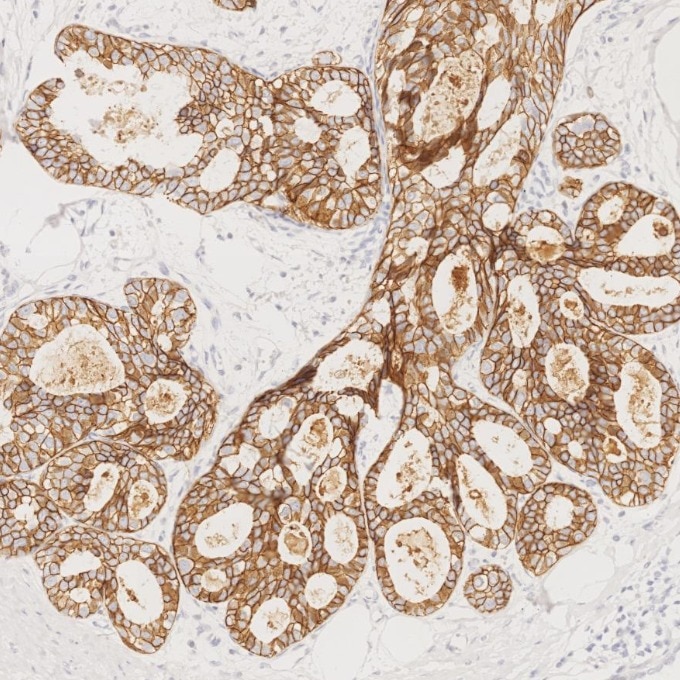 Immunohistochemistry (IHC) staining of human breast cancer tissue using E-cadherin Recombinant monoclonal antibody (83991-4-RR)