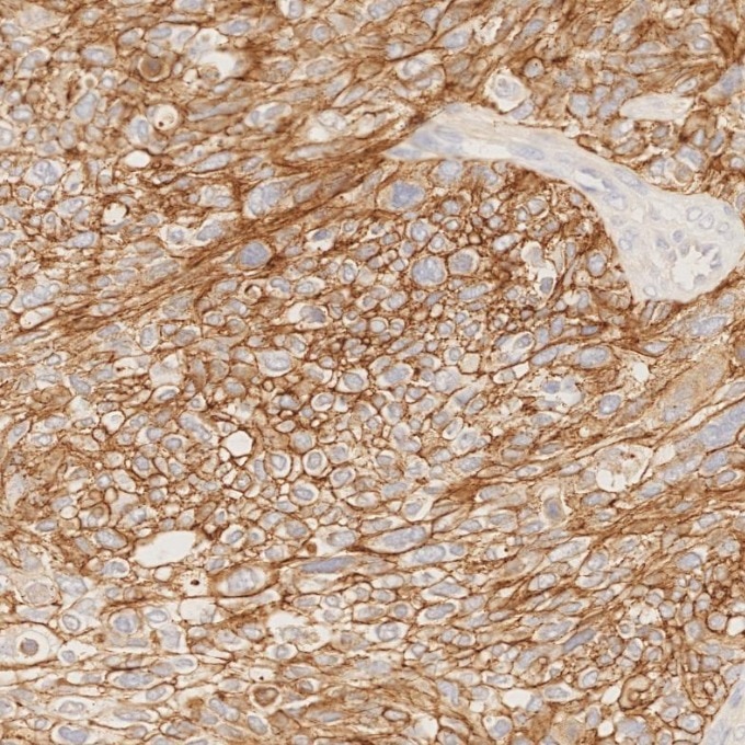 Immunohistochemistry (IHC) staining of human ovary cancer tissue using E-cadherin Recombinant monoclonal antibody (83991-4-RR)