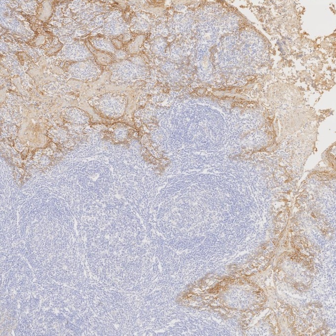 Immunohistochemistry (IHC) staining of human tonsillitis tissue using E-cadherin Recombinant monoclonal antibody (83991-4-RR)