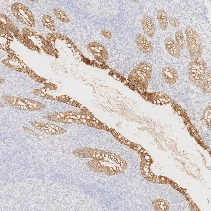 Immunohistochemistry (IHC) staining of human appendicitis tissue using E-cadherin Recombinant monoclonal antibody (83991-4-RR)