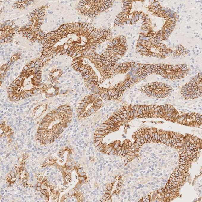 Immunohistochemistry (IHC) staining of human stomach cancer tissue using E-cadherin Recombinant monoclonal antibody (83991-4-RR)