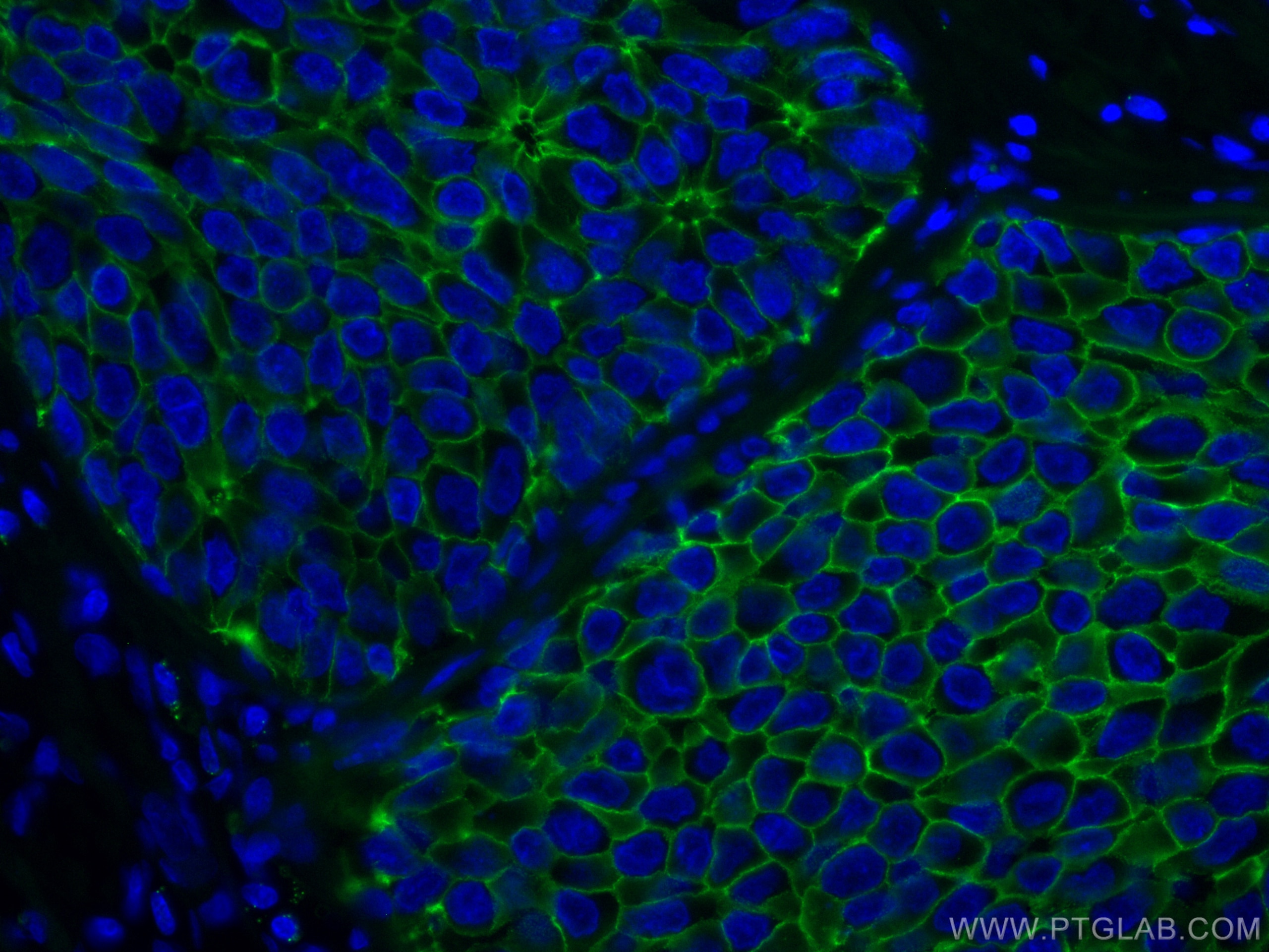 Immunofluorescence (IF) / fluorescent staining of human breast cancer tissue using CoraLite® Plus 488-conjugated E-cadherin Monoclona (CL488-60335)