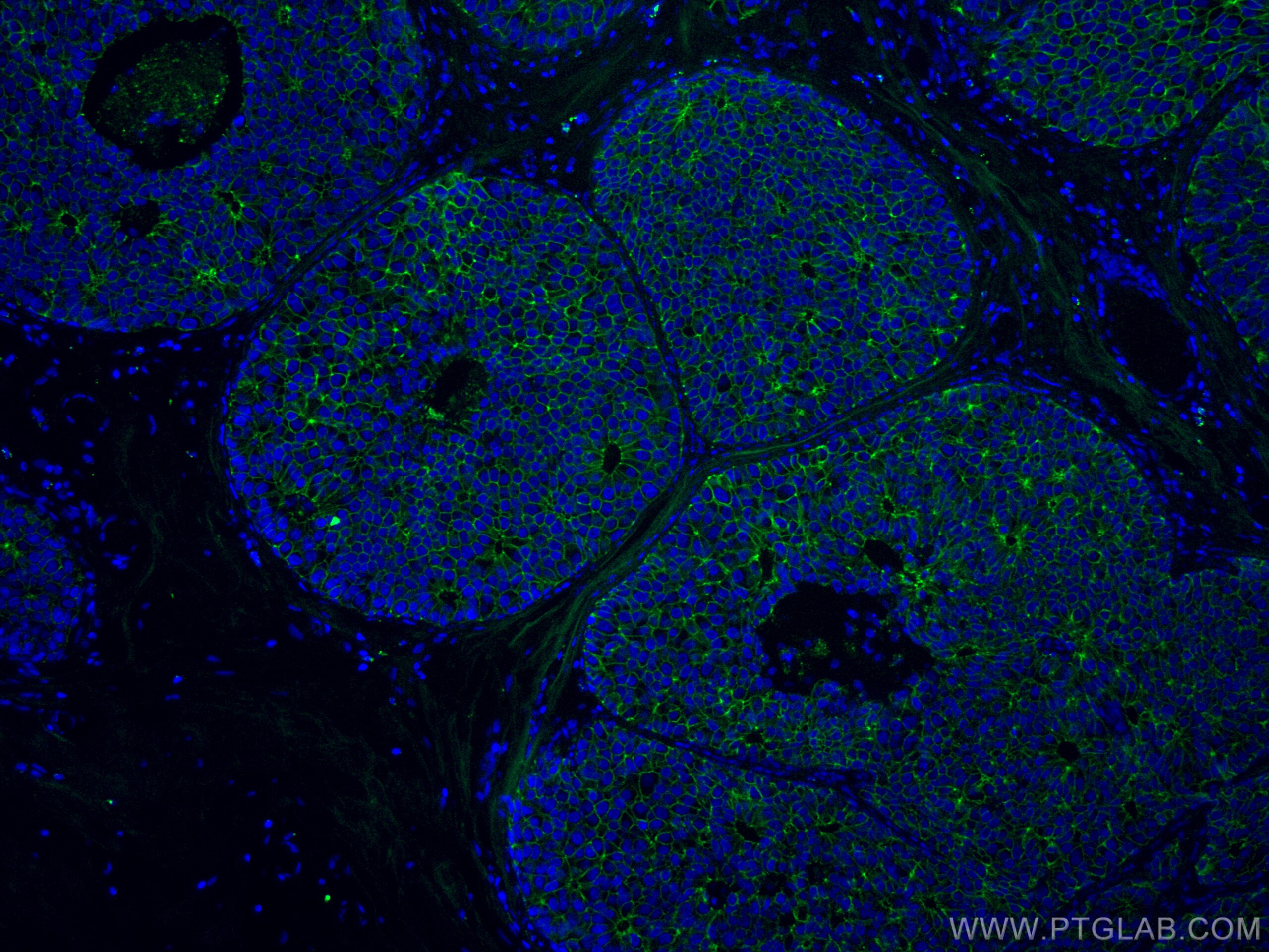 Immunofluorescence (IF) / fluorescent staining of human breast cancer tissue using CoraLite® Plus 488-conjugated E-cadherin Monoclona (CL488-60335)