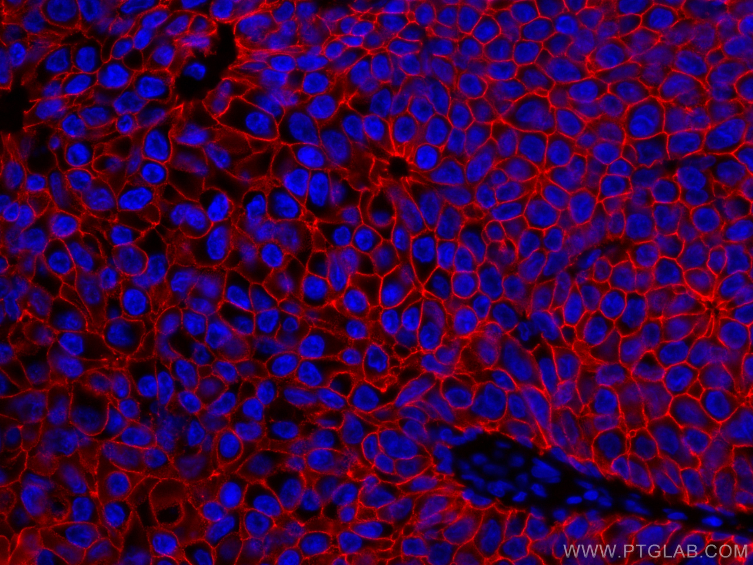 Immunofluorescence (IF) / fluorescent staining of human breast cancer tissue using CoraLite®594-conjugated E-cadherin Monoclonal anti (CL594-60335)
