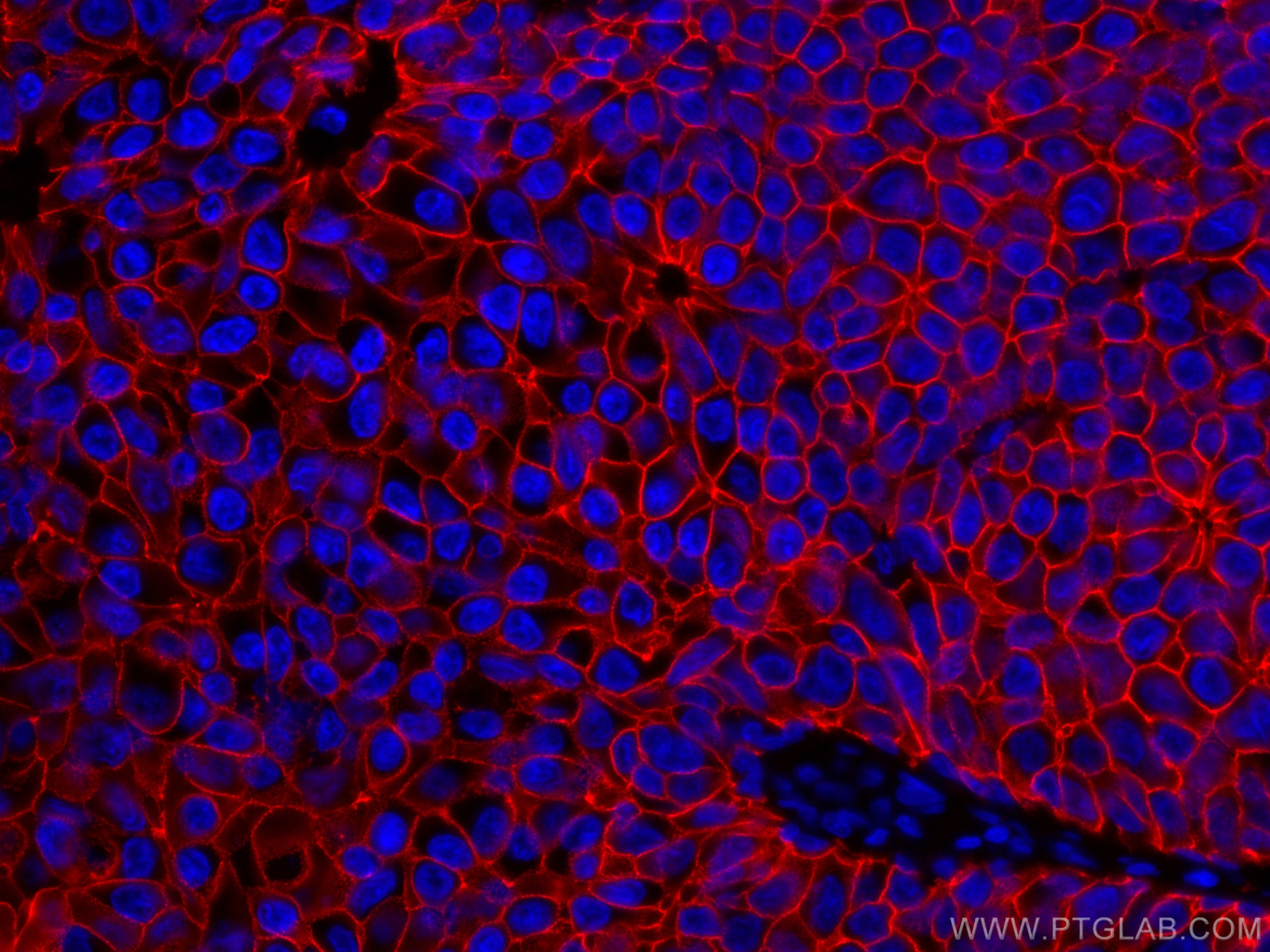 IF Staining of human breast cancer using CL594-60335