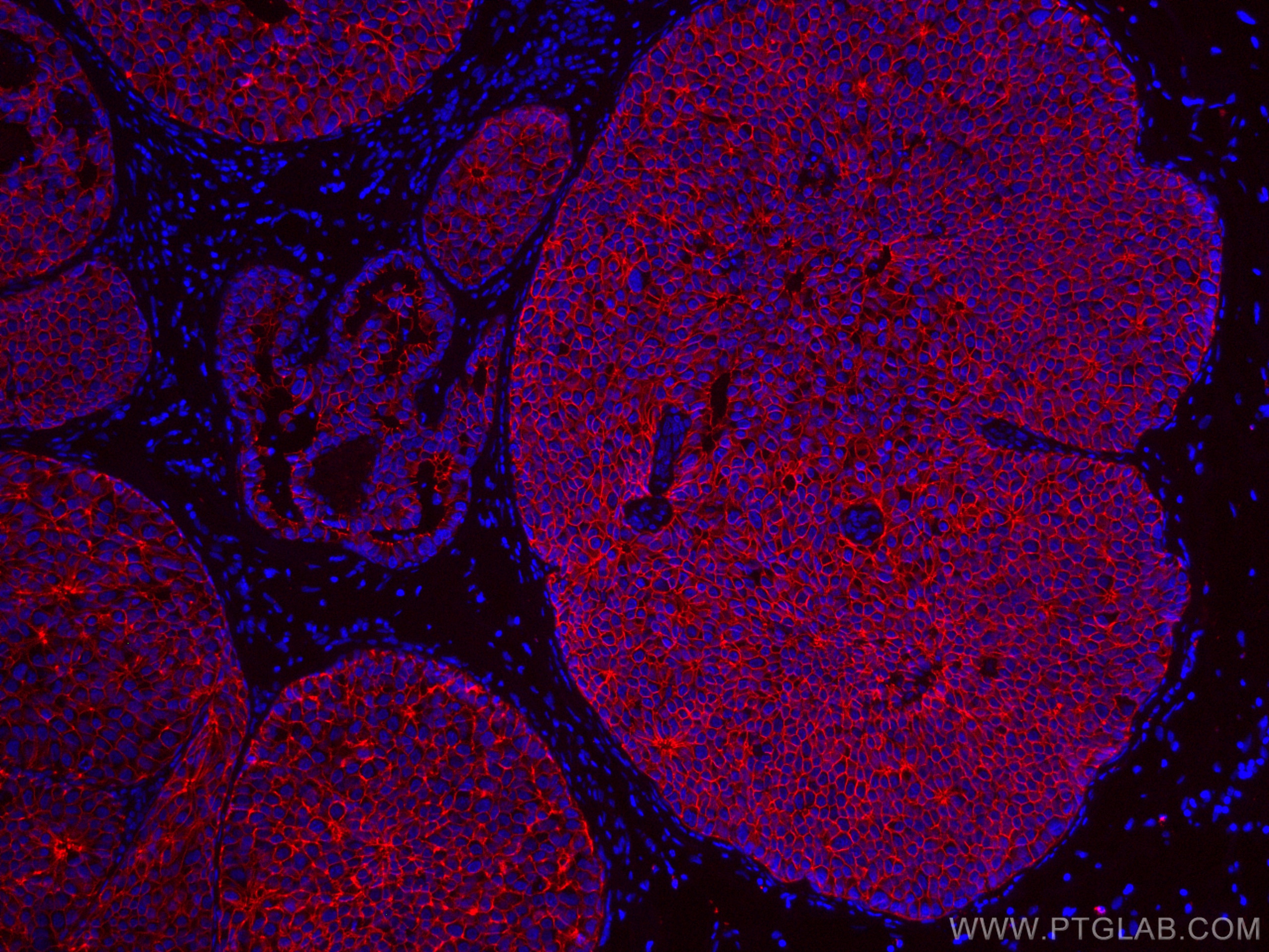 Immunofluorescence (IF) / fluorescent staining of human breast cancer tissue using CoraLite®594-conjugated E-cadherin Monoclonal anti (CL594-60335)