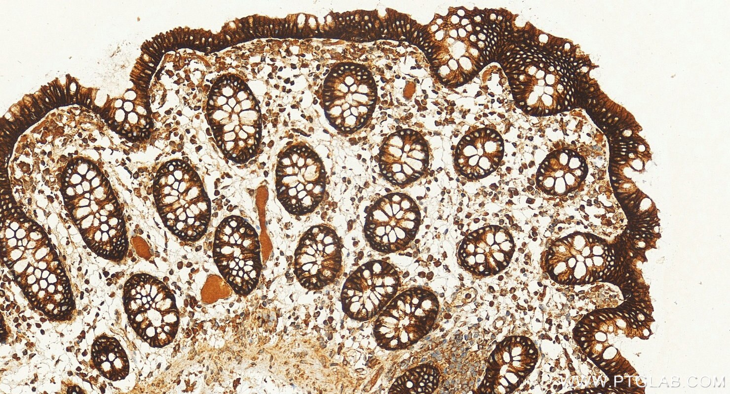 Immunohistochemical analysis of paraffin-embedded human colon tissue slide using RMX00039 (E-cadherin antibody) at dilution of 1:400 (under 20x lens). Heat mediated antigen retrieval with Tris-EDTA buffer (pH 9.0). Immunohistochemistry (IHC) staining of human colon tissue using Multi-rAb® E-cadherin Multi-Recombinant antibody (RMX00039)
