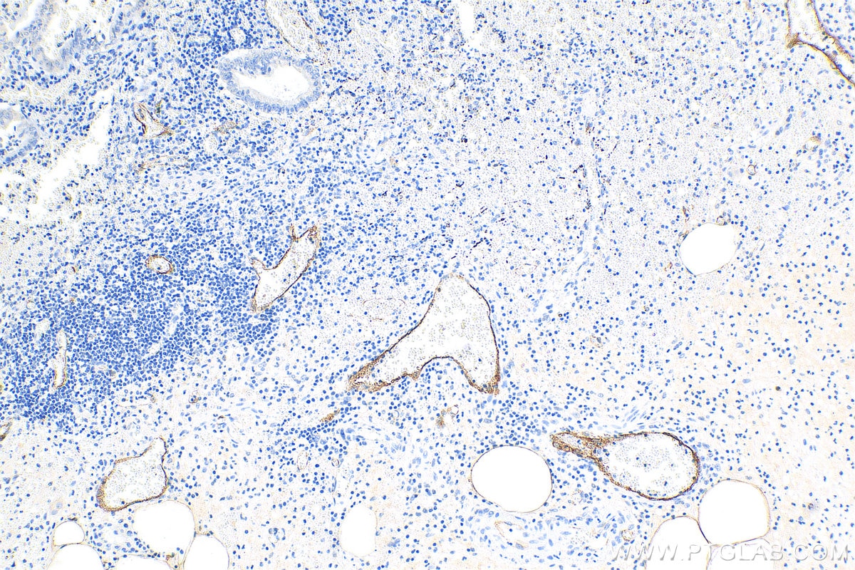 Immunohistochemistry (IHC) staining of human appendicitis tissue using E-selectin / CD62E Polyclonal antibody (30205-1-AP)