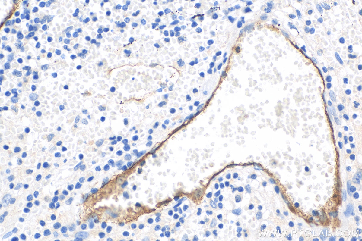 Immunohistochemistry (IHC) staining of human appendicitis tissue using E-selectin / CD62E Polyclonal antibody (30205-1-AP)