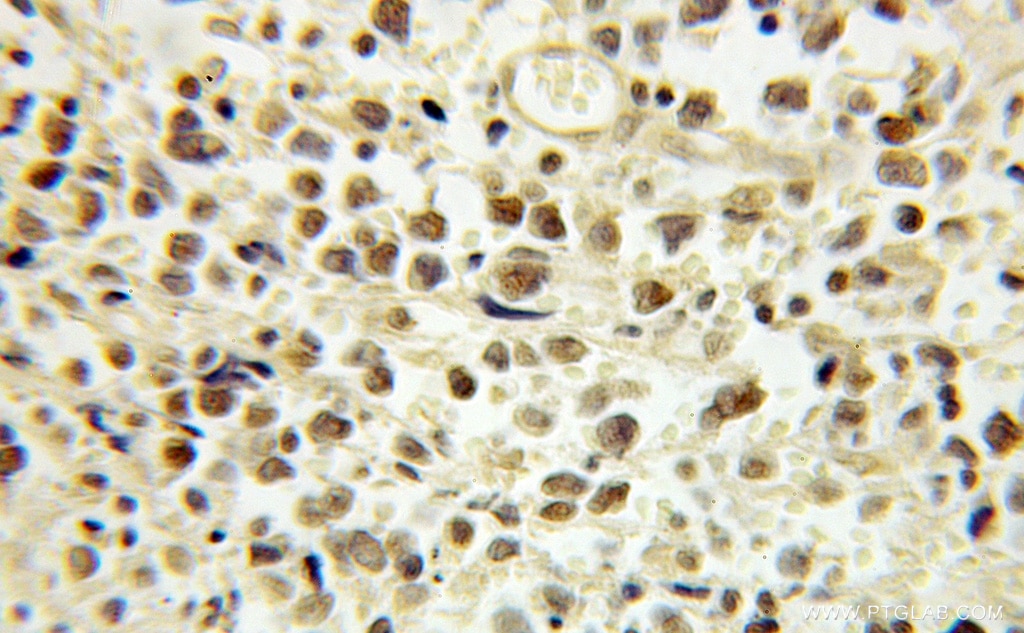 Immunohistochemistry (IHC) staining of human lymphoma tissue using E2F4 Polyclonal antibody (10923-1-AP)