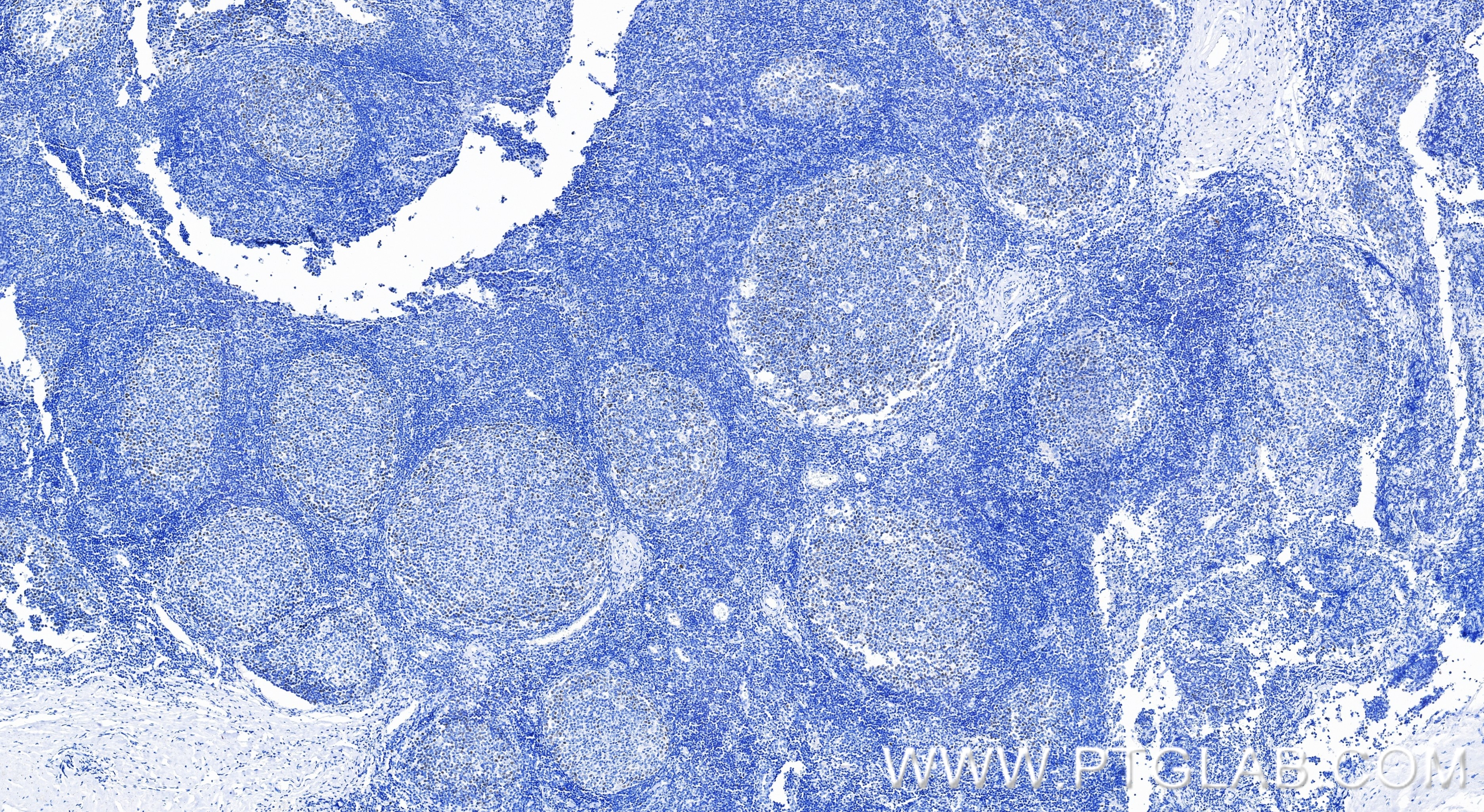 Immunohistochemistry (IHC) staining of human tonsillitis tissue using E2F8 Recombinant monoclonal antibody (86645-1-RR)