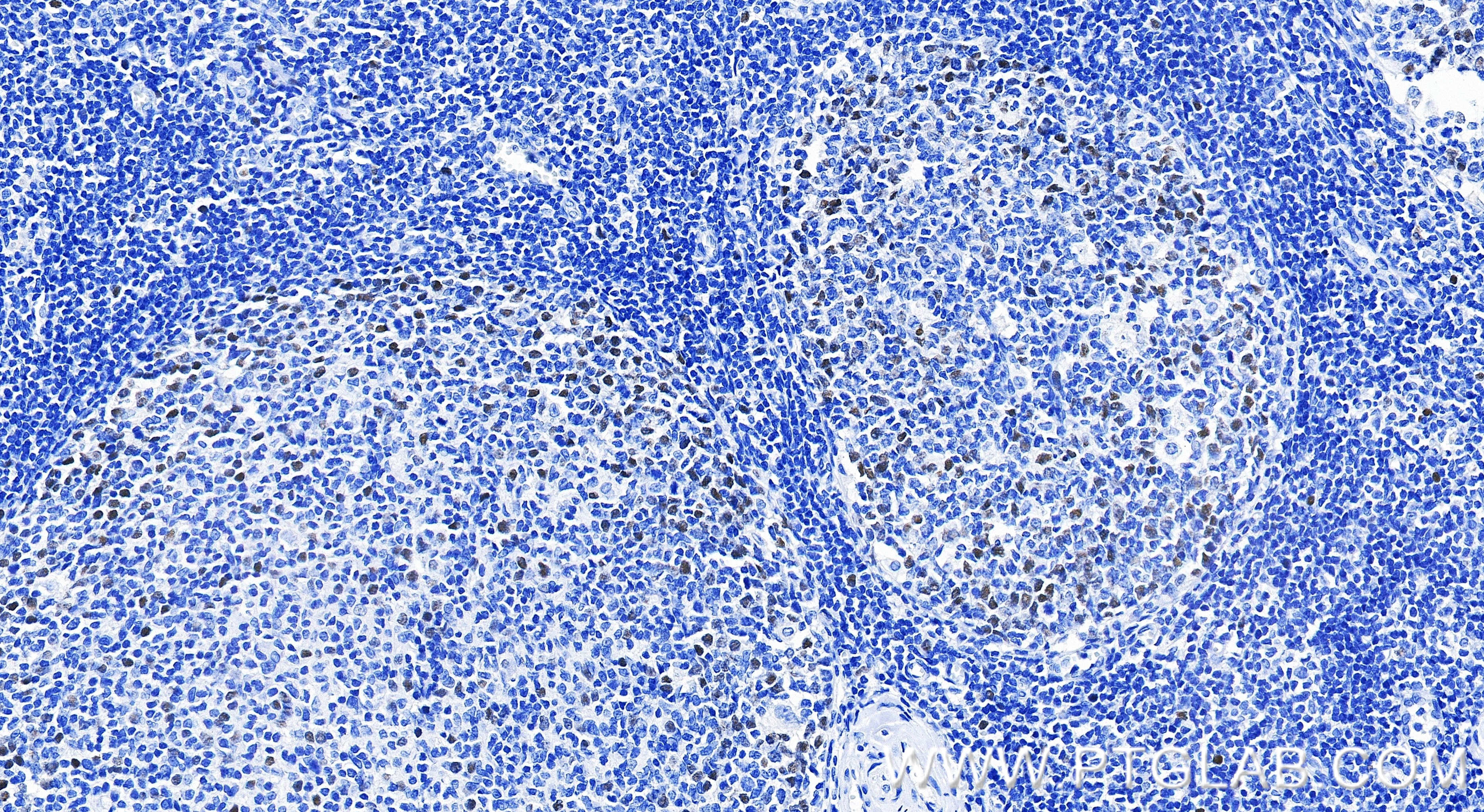 Immunohistochemistry (IHC) staining of human tonsillitis tissue using E2F8 Recombinant monoclonal antibody (86645-1-RR)