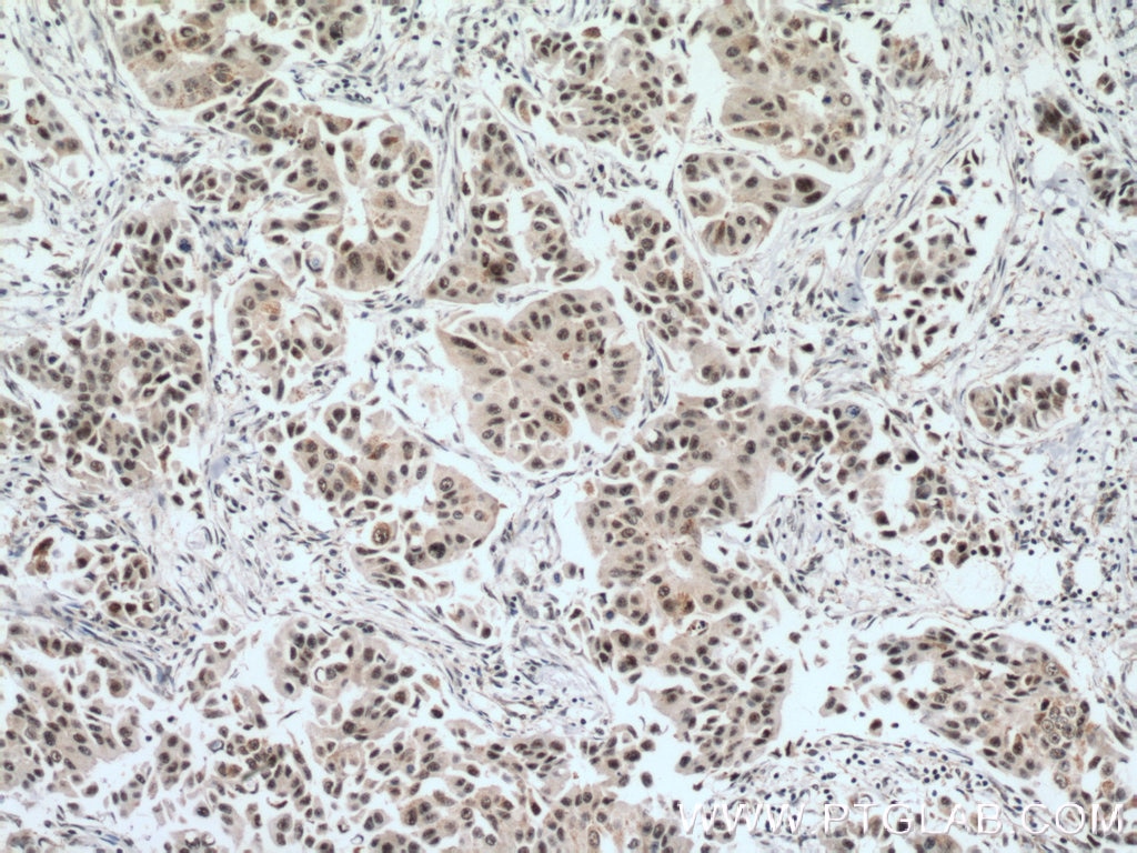 IHC staining of human breast cancer using 11172-1-AP