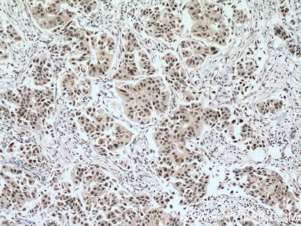 Immunohistochemistry (IHC) staining of human breast cancer tissue using EAF2 Polyclonal antibody (11172-1-AP)