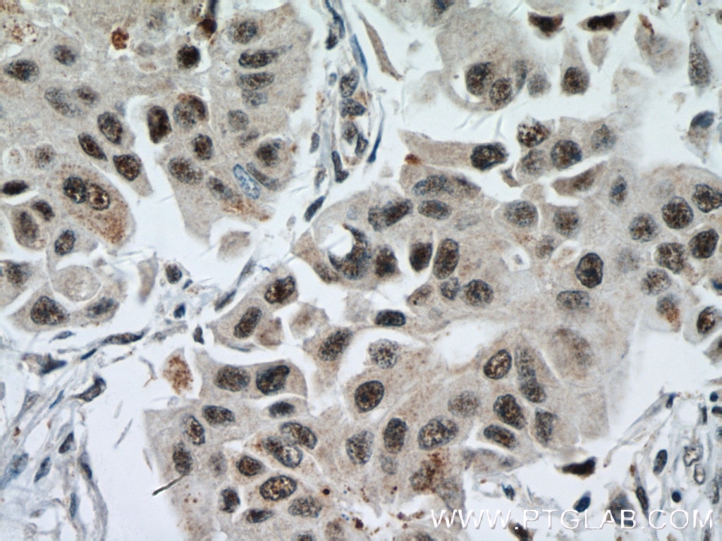 Immunohistochemistry (IHC) staining of human breast cancer tissue using EAF2 Polyclonal antibody (11172-1-AP)