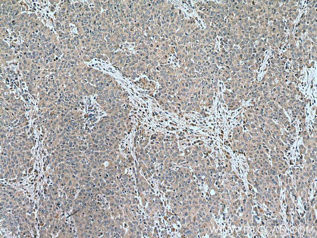 Immunohistochemistry (IHC) staining of human stomach cancer tissue using EBF1 Polyclonal antibody (14159-1-AP)