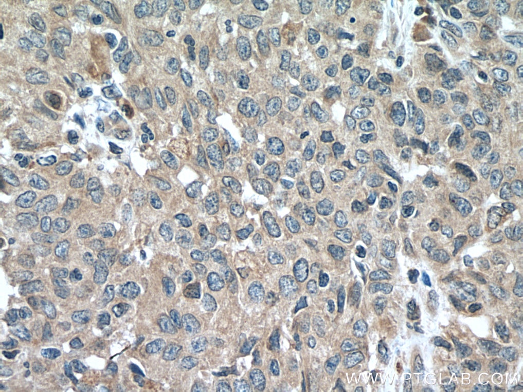 Immunohistochemistry (IHC) staining of human stomach cancer tissue using EBF1 Polyclonal antibody (14159-1-AP)