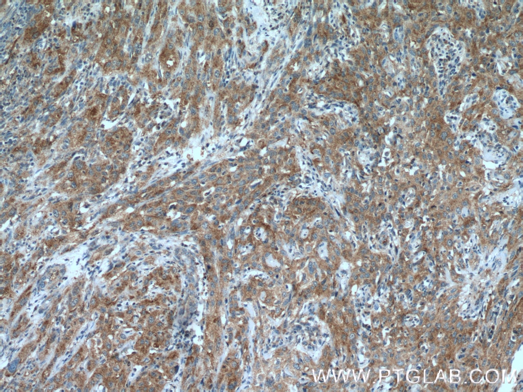Immunohistochemistry (IHC) staining of human cervical cancer tissue using EBP Polyclonal antibody (12968-1-AP)