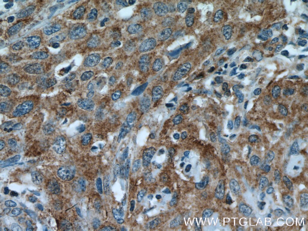 Immunohistochemistry (IHC) staining of human cervical cancer tissue using EBP Polyclonal antibody (12968-1-AP)