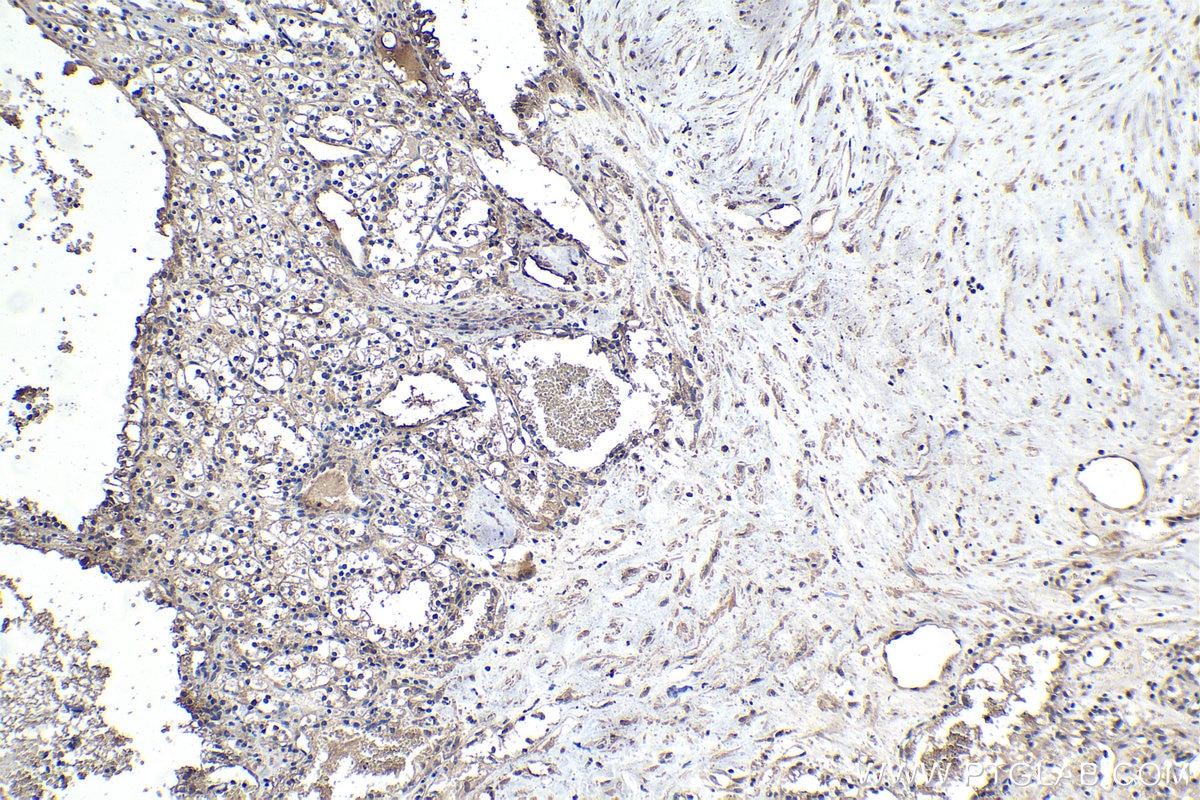 Immunohistochemistry (IHC) staining of human renal cell carcinoma tissue using ECD Monoclonal antibody (67179-1-Ig)